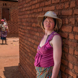 Alþjóðlegur dagur fólks með albinisma: „Fólk kallar mig peninga, þau hóta mér“